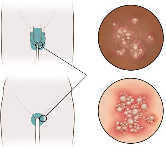 Die linke Seite der Grafik zeigt in einer vereinfachten anatomischen Zeichnung, wo im Genitalbereich Genitalherpes bei Männern und Frauen auftritt. Die rechte Seite zeigt eine Detailansicht der Herpesbläschen.