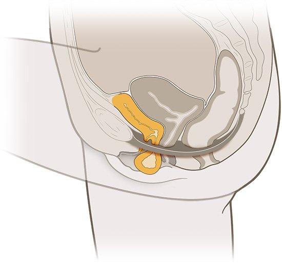 Die vereinfachte anatomische Grafik zeigt eine Blasensenkung (in gelb).