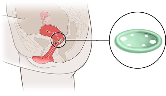 Die vereinfachte anatomische Grafik zeigt ein Schalenpessar (Detailansicht, in grün) und seine Lage im weiblichen Unterleib.