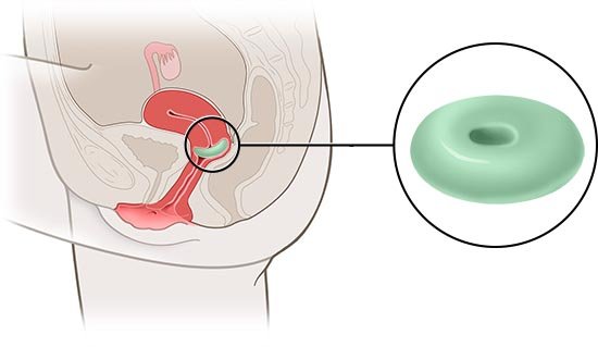 Die vereinfachte anatomische Grafik zeigt ein Ringpessar (Detailansicht, in grün) und seine Lage im weiblichen Unterleib.