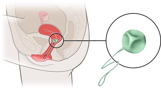 Die vereinfachte anatomische Grafik zeigt ein Würfelpessar (Detailansicht, in grün) und seine Lage im weiblichen Unterleib.