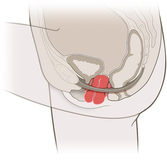 Die vereinfachte anatomische Grafik zeigt einen Gebärmuttervorfall (in rot).