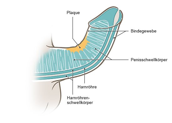 Die Grafik zeigt die vereinfachte anatomische Darstellung eines gekrümmten Penis mit Verhärtungen des Bindegewebes (Plaque-Knötchen).