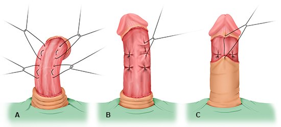 Die Grafik zeigt die einzelnen Schritte bei einer operativen Raffung des Penis-Bindegewebes.