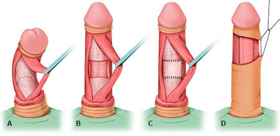 Die Grafik zeigt die vereinfachte anatomische Darstellung einer operativen Penis-Plastik mit Gewebe-Transplantat (Graft) in vier Schritten.