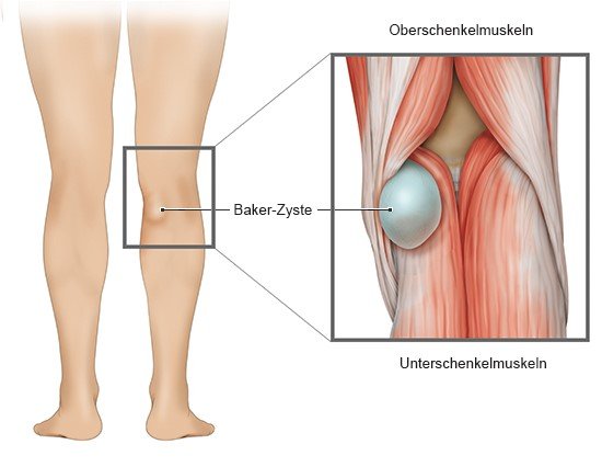 Die Grafik links zeigt eine Kniekehle mit Baker-Zyste. Rechts wird die Lage der Zyste zwischen Ober- und Unterschenkelmuskeln dargestellt.