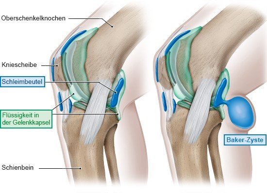 Die linke Grafik zeigt ein gesundes Kniegelenk. In der rechten Grafik ist ein Knie mit Baker-Zyste in der Kniekehle abgebildet.