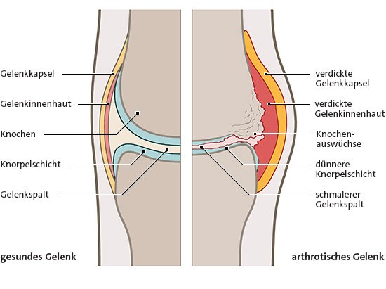 Veränderungen am Gelenk durch Arthrose