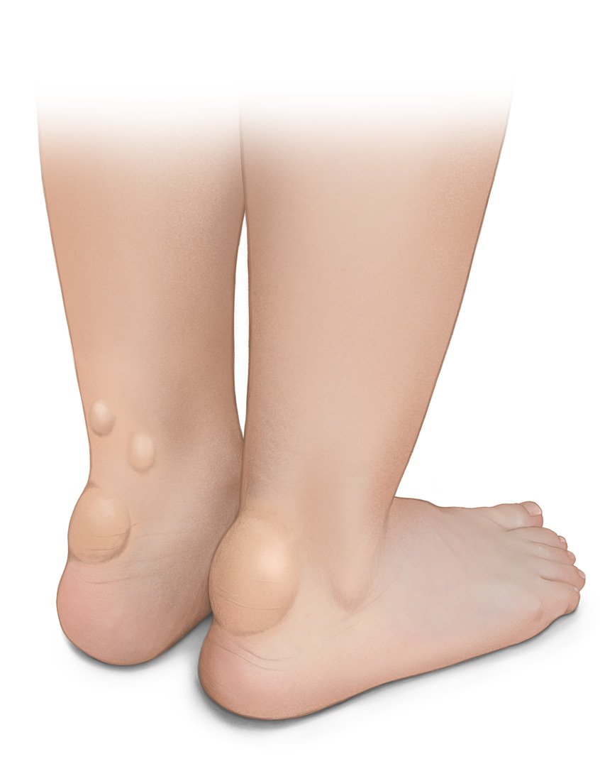 Die fotorealistische Grafik zeigt Cholesterinablagerungen an der Achillessehne.