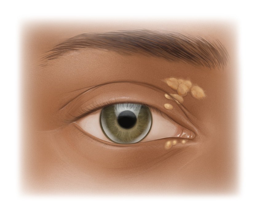 Die fotorealistische Grafik zeigt Cholesterinablagerungen am Augenlid und in der Iris.