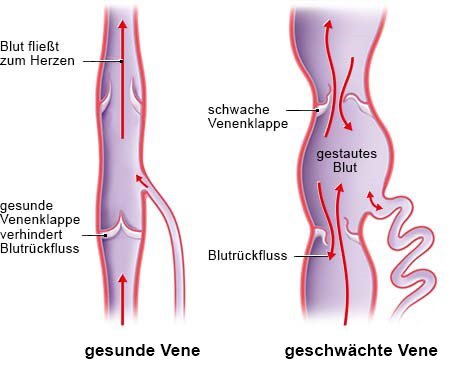 Die vereinfachte anatomische Grafik zeigt, wie der Blutrückfluss bei einer gesunden (links) und einer geschwächten Vene funktioniert.