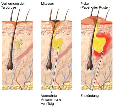 Die Grafik zeigt links die Verhornung einer Talgdrüse, daneben die Ansammlung von Talg bei einem Mitesser und rechts einen entzündeten Pickel.