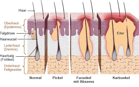 Die vereinfachte anatomische Grafik zeigt mögliche Infektionen am Haarbalg