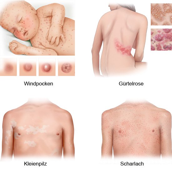Die fotorealistische Grafik zeigt typische Hautveränderungen bei den Infektionskrankheiten Windpocken, Gürtelrose, Kleienpilz und Scharlach.