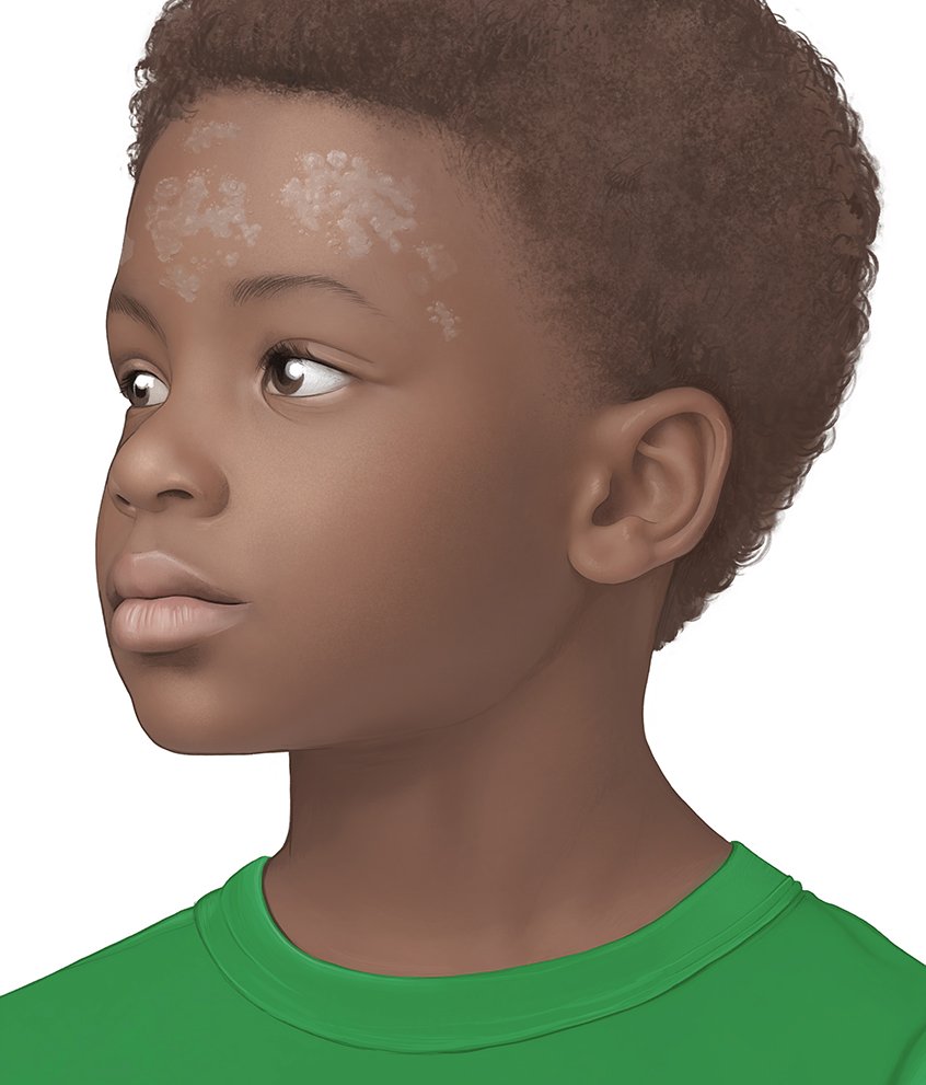Die fotorealistische Grafik zeigt das Gesicht eines Jungen mit Kleienpilzflechte. Gezeigt werden an der Stirn helle Flecken auf dunkler Haut.