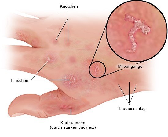 Die Grafik zeigt den für Krätze typischen Hautausschlag. Neben Knötchen, Bläschen und Wunden werden in Detailansicht Milbengänge abgebildet.