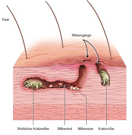 Die Grafik zeigt Krätzmilben in ihrem Gangsystem unter der Haut – mit Milbeneiern und Milbenkot.