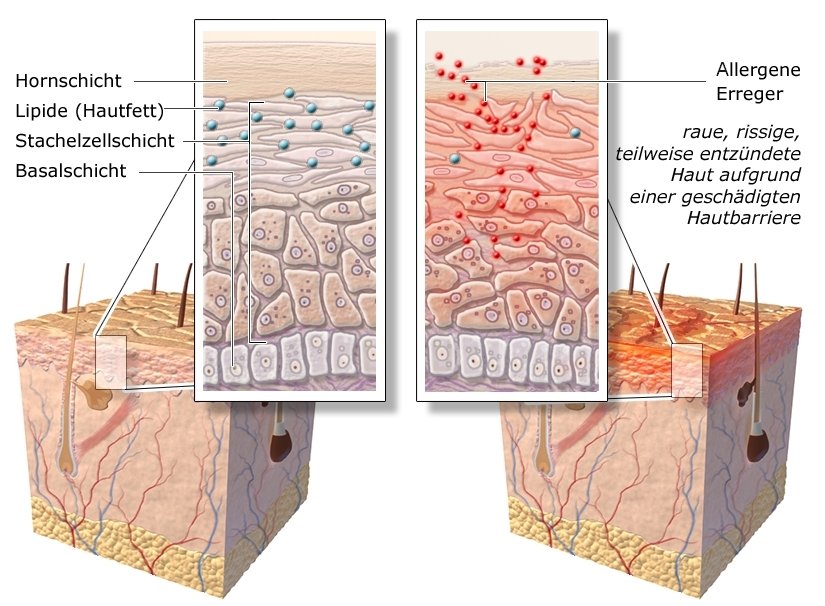 Die anatomische Grafik zeigt den Aufbau der Hautschichten mit Detailansicht: Links bei gesunder Haut, rechts bei von Neurodermitis betroffener Haut.
