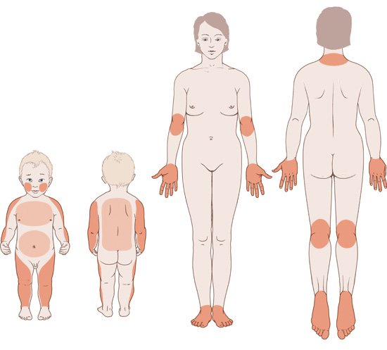 Die vereinfachte anatomische Grafik zeigt in orangefarbener Hervorhebung, welche Haustellen auf der Vor- und Rückseite des Körpers bei Babys (links) und Erwachsenen (rechts) von einer Neurodermitis betroffen sein können.