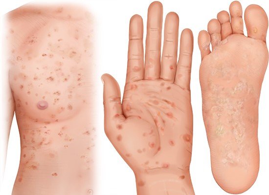 Mögliche Hautausschläge bei Syphilis