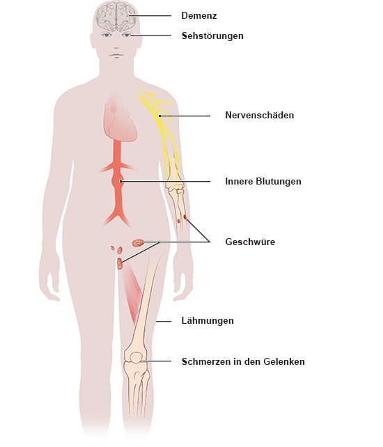Mögliche Spätfolgen der Syphilis