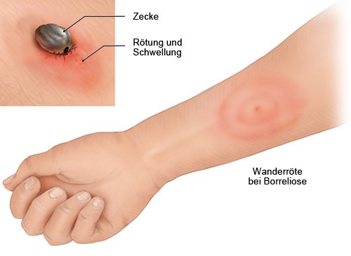 Die fotorealistische Grafik zeigt das typische Symptom einer Borreliose nach Zeckenstich am Unterarm - die Wanderröte.