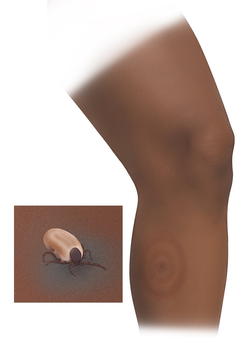 Die fotorealistische Grafik zeigt die Hautveränderung nach einem Zeckenstich und eine Wanderröte am Unterschenkel auf dunkler Haut.
