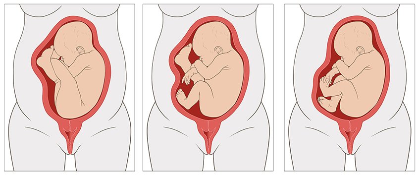 Die vereinfachte anatomische Grafik zeigt ein ungeborenes Kind in reiner Steißlage (links), unvollkommener Steiß-Fuß-Lage (Mitte) und vollkommener Steiß-Fuß-Lage (rechts).