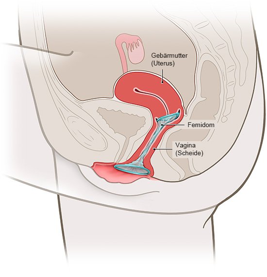 Die Grafik zeigt die Lage des Femidoms in der Vagina.