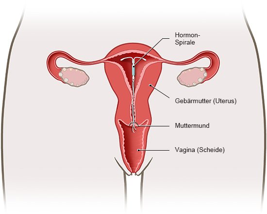 Die Grafik zeigt die Lage der Hormonspirale in der Gebärmutter.