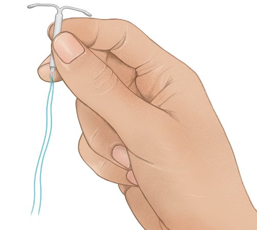 Die Grafik zeigt eine Hormonspirale. Sie besteht aus einem T-förmigen, etwa drei Zentimeter langen Kunststoffstäbchen mit einem Hormondepot.
