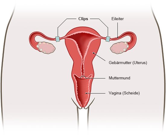Die Grafik zeigt die Tubensterilisation. Dabei werden die Eileiter verschlossen. Es ist eins der beiden Verfahren zur Sterilisation der Frau.