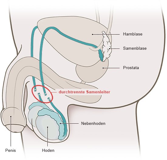 Die Grafik zeigt die Vasektomie zur Sterilisation des Mannes. Dabei werden die Samenleiter im Hodensack durchtrennt.