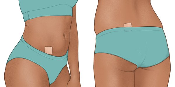 Die Grafik zeigt zwei mögliche Stellen zum Ankleben des Pflasters – am Bauch und unteren Rücken.