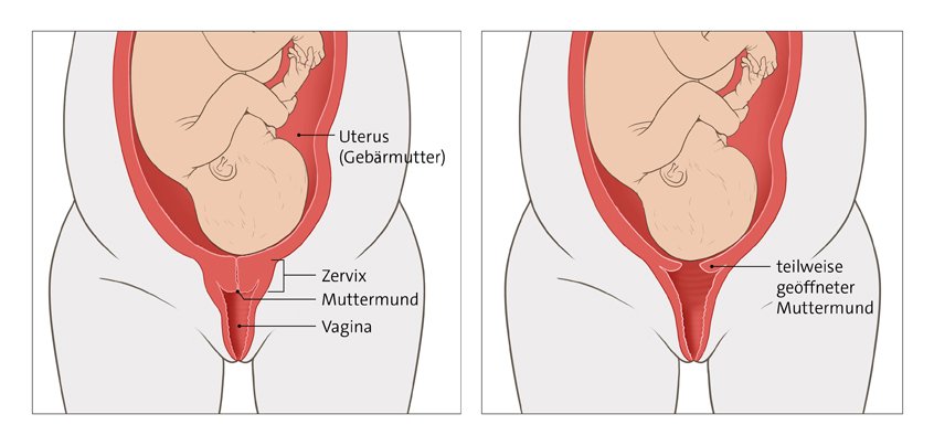 Die Grafik links zeigt ein Kind in der Gebärmutter bei geschlossenem Muttermund, rechts bei teilweise geöffnetem Muttermund.