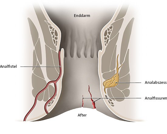 Die Grafik zeigt mögliche Komplikationen bei Morbus Crohn im Analbereich: eine Analfistel, einen Analabszess und Analfissuren.