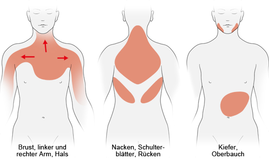 Grafik: Mögliche Schmerzregionen bei Herzinfarkt - wie im Text beschrieben