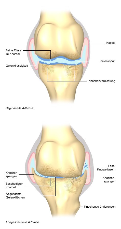 Grafik: beginnende und fortgeschrittene Arthrose im Gelenk