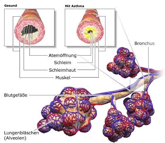 Grafik: Aufbau der Lungen-Atemwege; gesunde und durch Asthma verengte Bronchien - wie im Text beschrieben