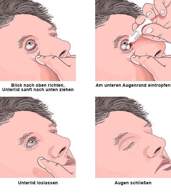 Anwendungsempfehlung für Augentropfen - wie im Text beschrieben