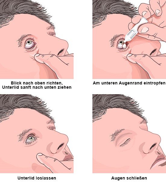 Augentropfen richtig anwenden Gesundheitsinformation.de