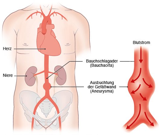 Grafik: Bauchschlagader und ausgebuchtete Gefäßwand (Aneurysma) - wie im Text beschrieben