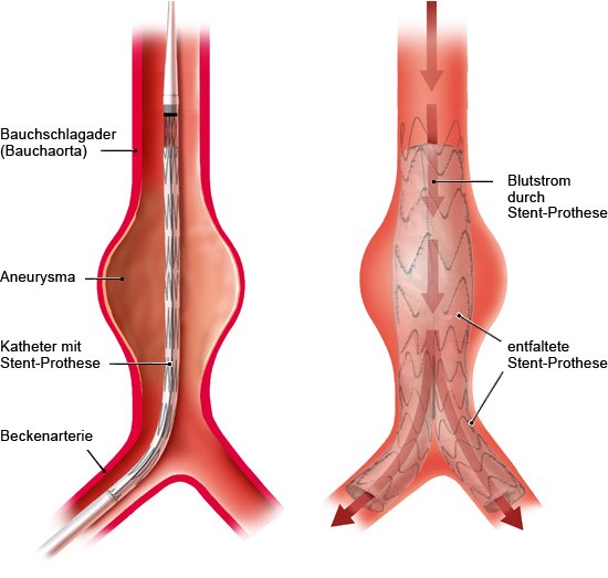 Grafik: endovaskulärer Eingriff mit Stent-Prothese