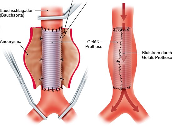 Grafik: offene Operation: Aneurysma wird durch künstliches Gefäßstück ersetzt