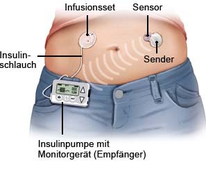 Grafik: CGM-Gerät mit Insulinpumpe