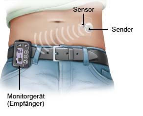 Grafik: CGM-System: kontinuierliche Zuckermessung im Unterhautgewebe