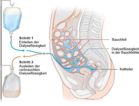 Grafik: Bei der Peritonealdialyse wird Dialyseflüssigkeit in die Bauchhöhle geleitet - wie im Text beschrieben