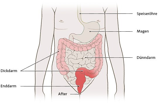 Die anatomische Grafik zeigt die auf den Enddarm begrenzte Entzündung bei einer Colitis ulcerose.