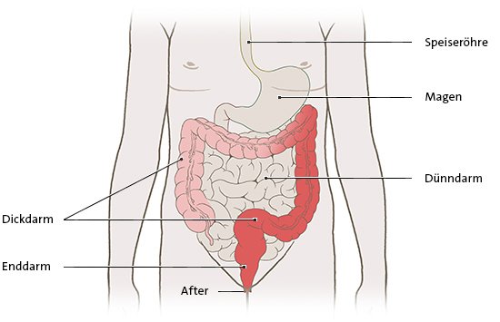 Die anatomische Grafik zeigt die Ausbreitung der Entzündung bei einer Colitis ulcerosa vom Enddarm auf einen Teil des benachbarten Dickdarms.