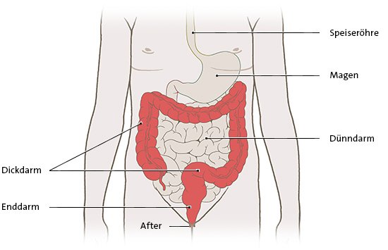 Die anatomische Grafik zeigt die Ausbreitung der Entzündung bei einer Colitis ulcerosa vom Enddarm auf den gesamten Dickdarm.